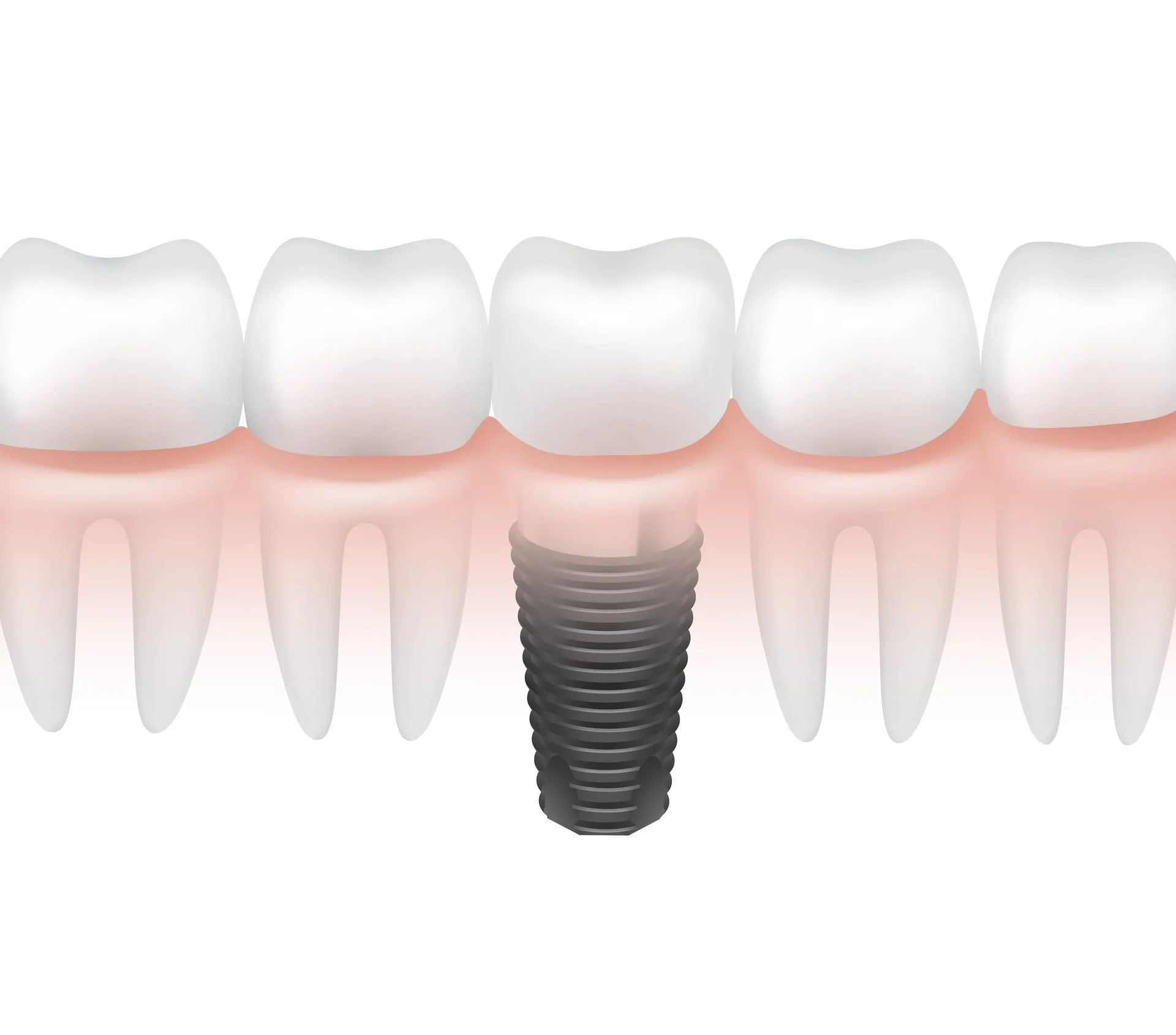 Implantes dentales en Clínica A+ Salud, Concepción