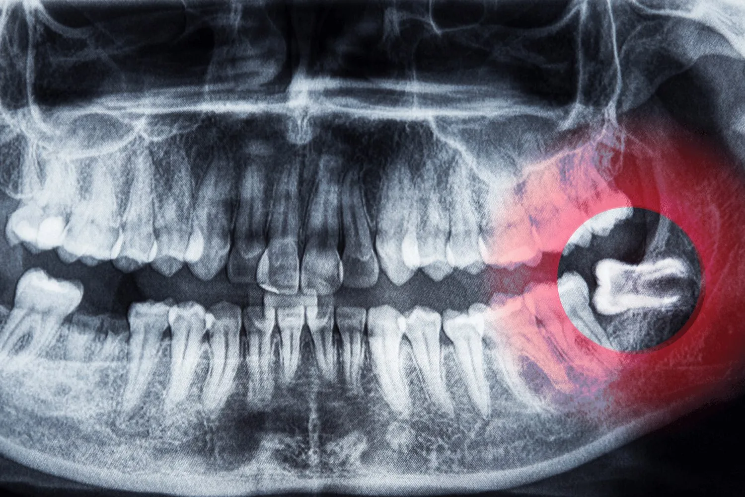 Cirugía oral en Clínica A+ Salud, Concepción