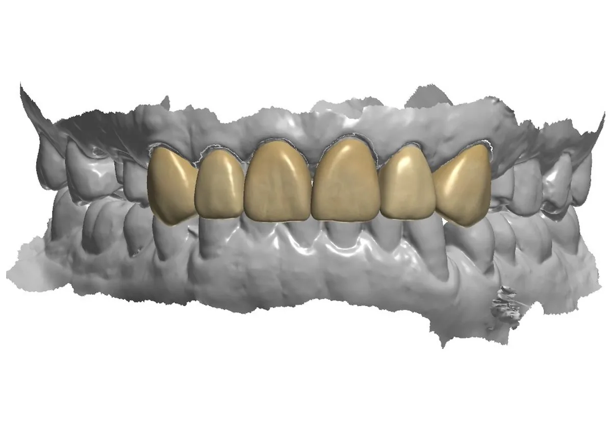 Planificación digital en 3D de un diseño de sonrisa