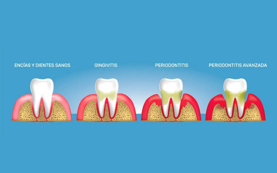 Etapas de la enfermedad periodontal: encías sanas, gingivitis, periodontitis y periodontitis avanzada