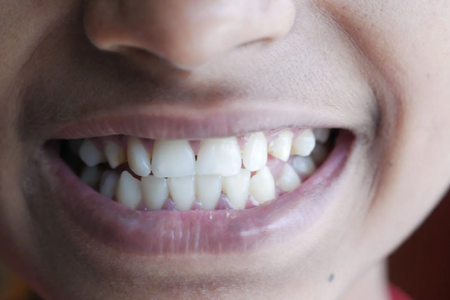 Encías sanas y dentadura completa, cuidado periodontal en Clínica A+ Salud